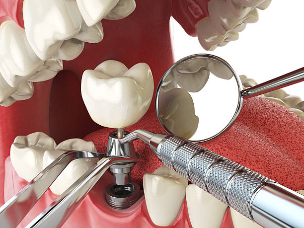 Best Knocked-Out Tooth (Avulsed Tooth) Treatment in Conyers, GA