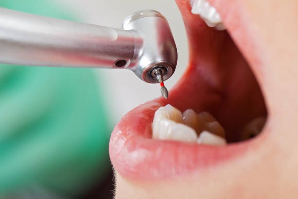 Best Emergency Wisdom Tooth Extraction in Conyers, GA